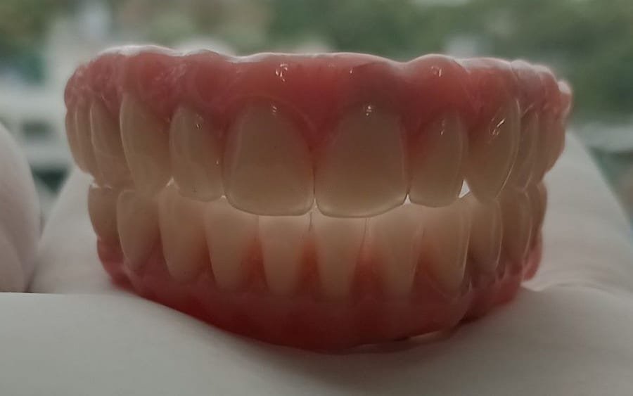 Prótese dentária sobre implantes