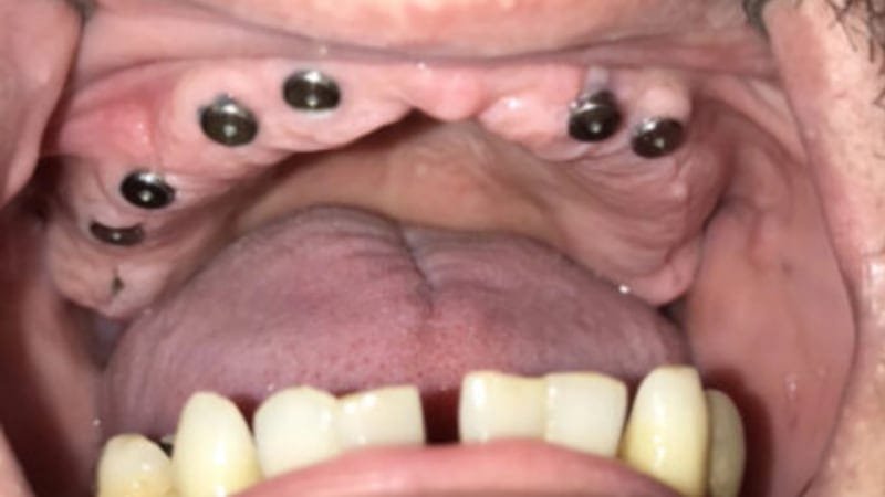 Implantes instalados na arcada superior