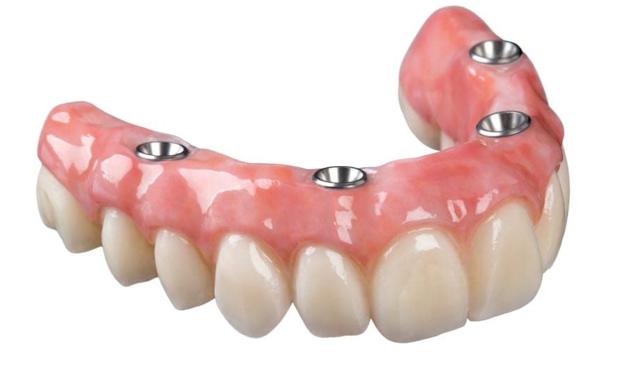 Prótese sobre implantes em porcelana com gengiva rosada