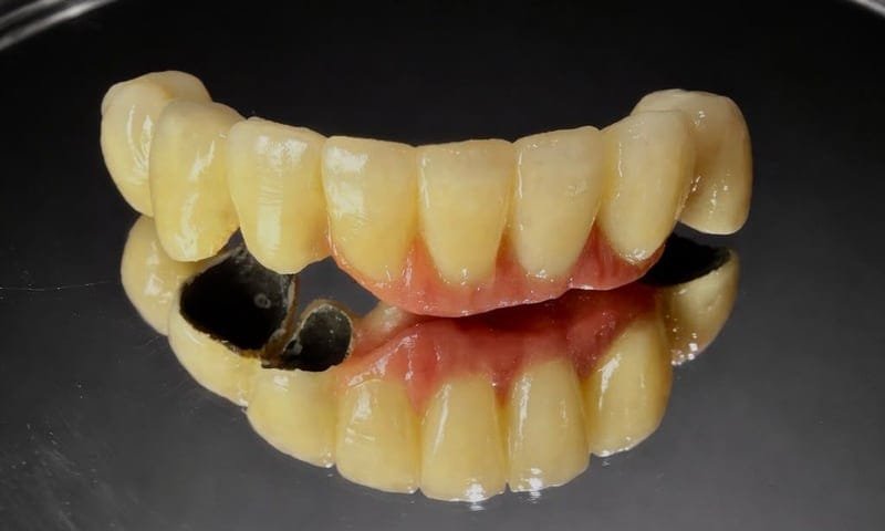 Prótese com gengiva artificial sobre superfície espelhada