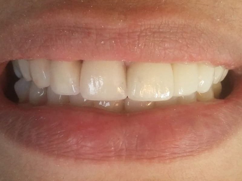 Sorriso com lentes de porcelana