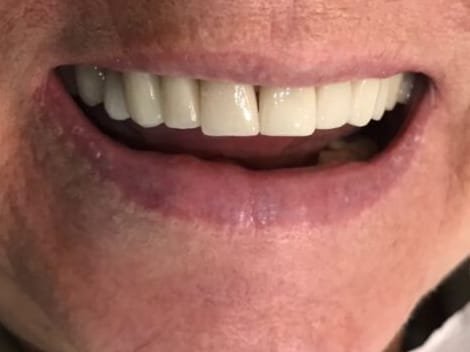 Sorriso com lentes de porcelana