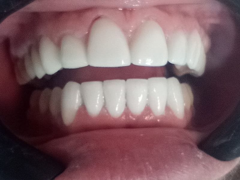Sorriso com lentes de porcelana